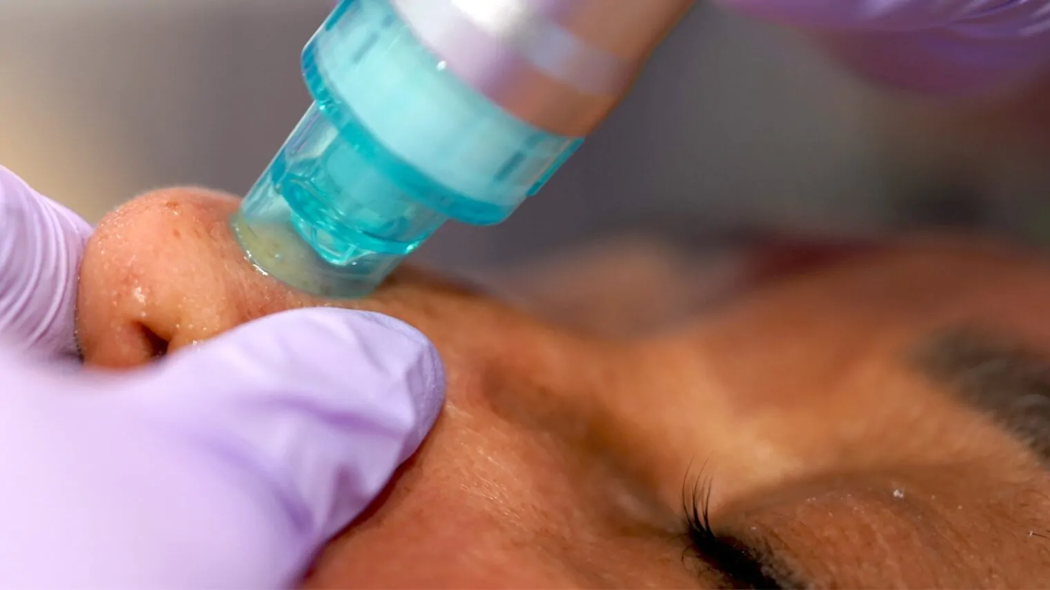 Top 5 Hydrodermabrasion Machine Benefits