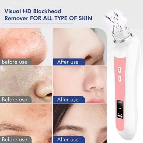 At Home Blackhead Remover Vacuum 6