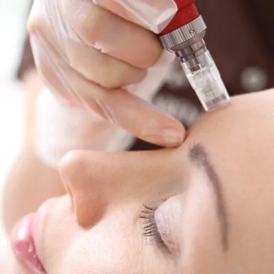 Microneedling Consumables