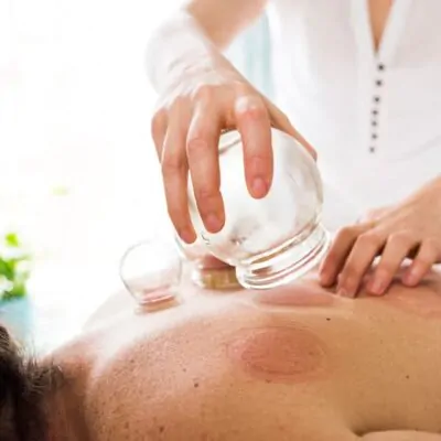 Cupping Therapy